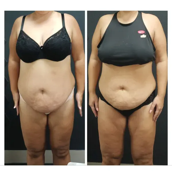 Before and after — flatter lower belly