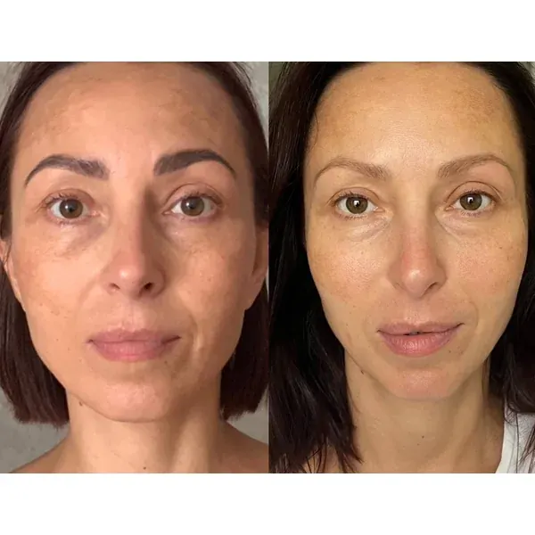 Before and after — more toned decollete
