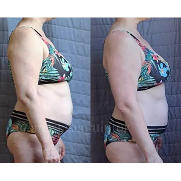 Before and after — reduced leg swelling